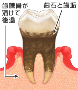 歯周病後期
