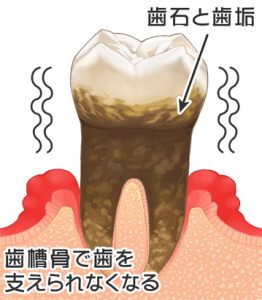 歯周病末期